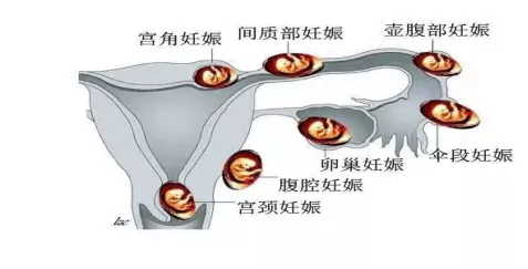 医学上又称异位妊娠,是指受精卵附着和生长在子宫体腔之外的部位