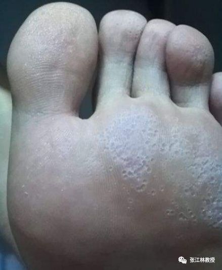 脚气用醋泡真的有效吗