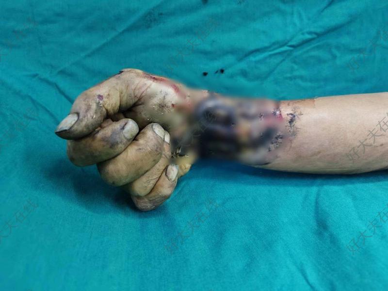 手腕离断_手外伤 - 好大夫在线