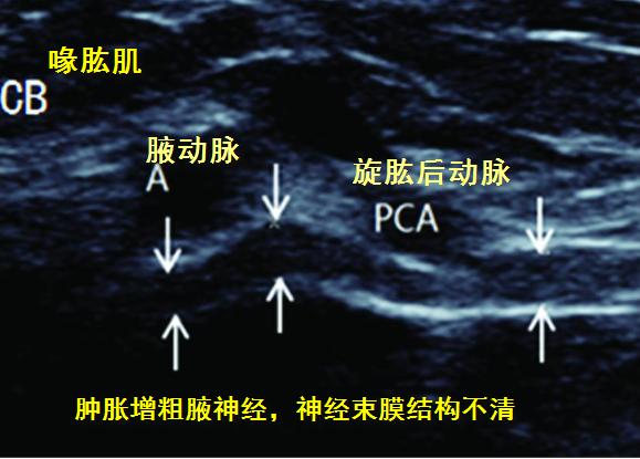 腋路臂丛神经超声图片图片