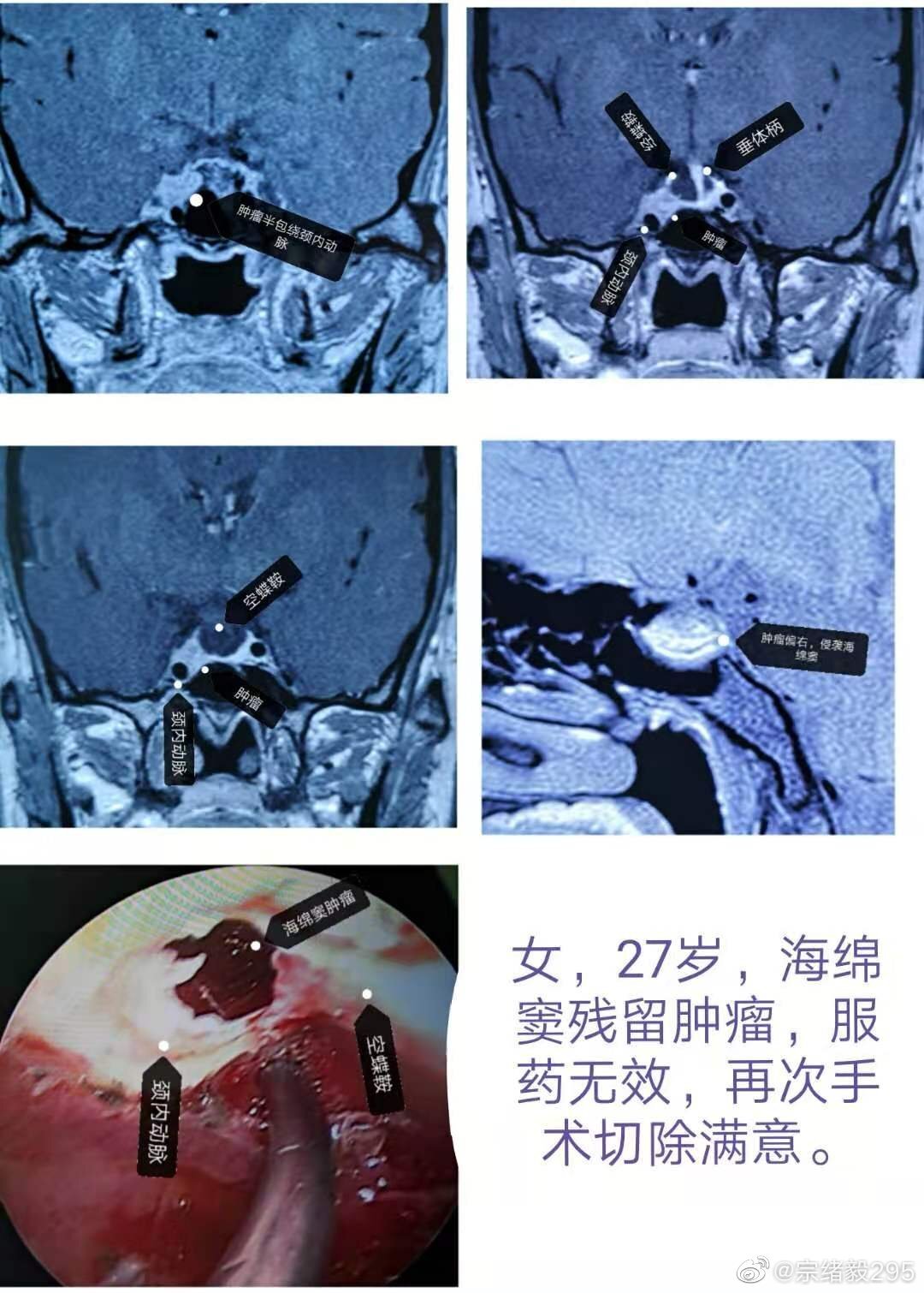 生长激素腺瘤的最佳处理方式