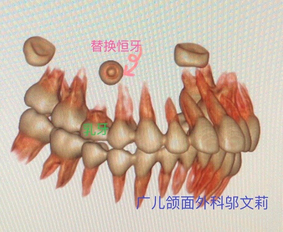 【日間手術】多生牙/埋伏牙的外科-正畸聯合治療_多生牙_多生牙日常