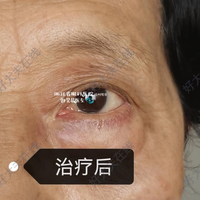 眶脂肪脱垂_眼部整形 - 好大夫在线