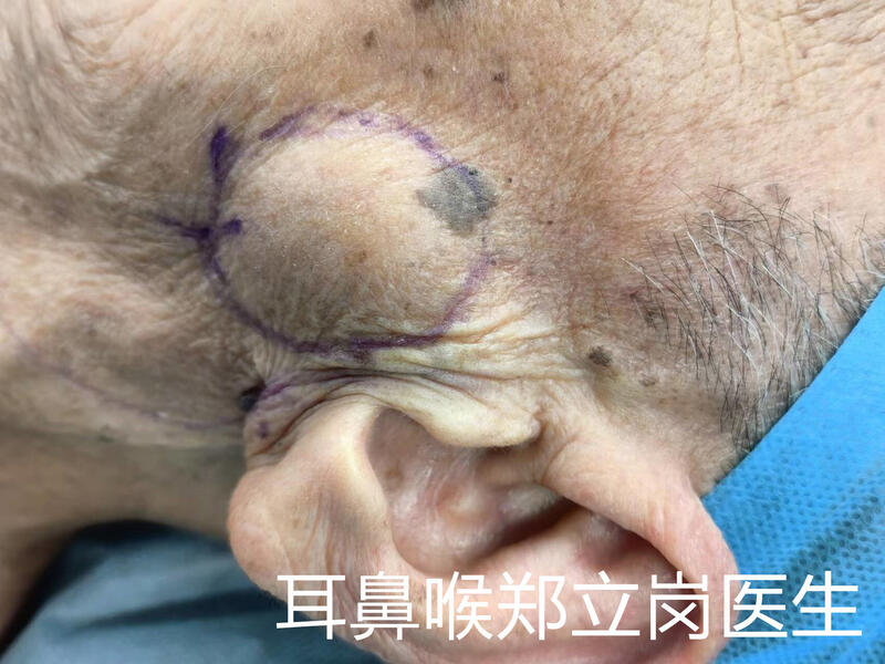 先天性腮腺囊肿图片