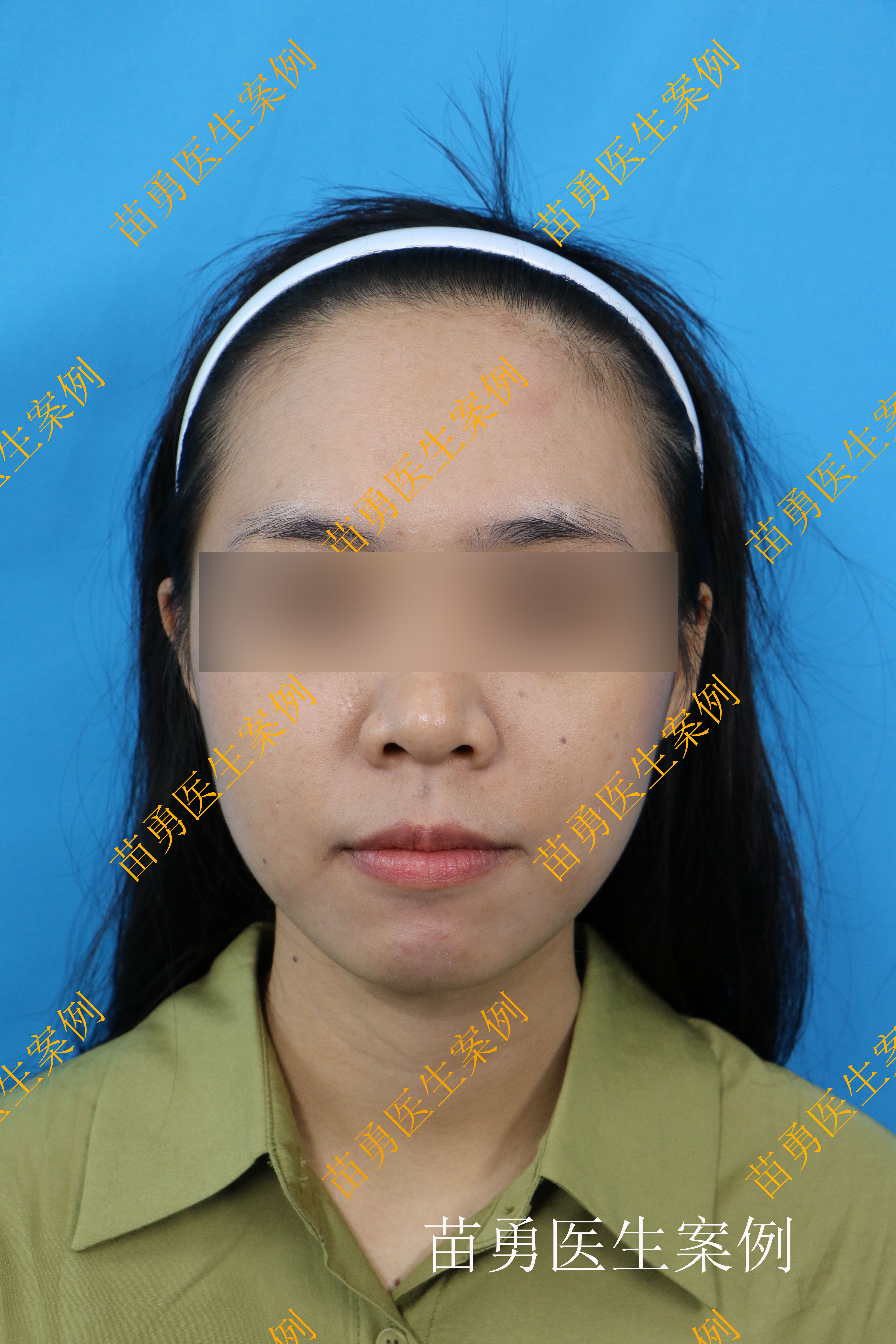 女生植发需要多久(女生植发多久能恢复正常生活)