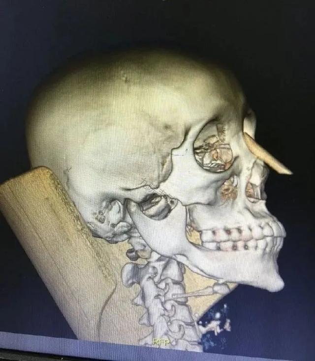 下颌骨截多长才算长曲线截骨