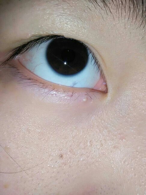 眼睛周围长白色的米粒是什么?怎么样处理?