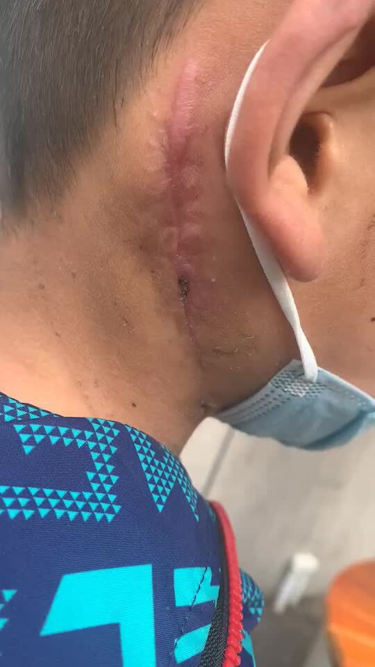 郑州大学第一附属医院小儿外科治疗淋巴管瘤怎么样_口碑_患者评价-好