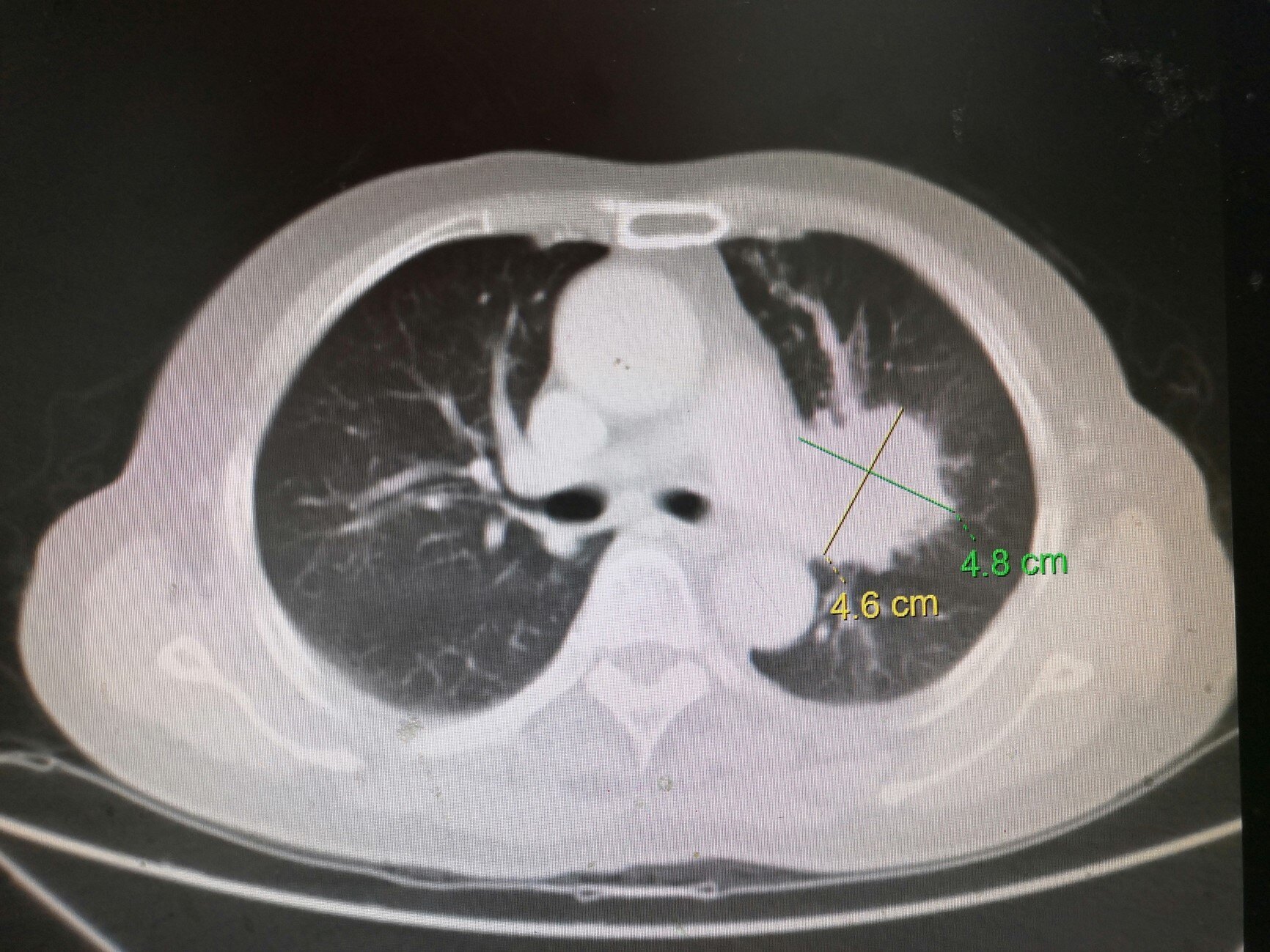 肺癌增强ct图片