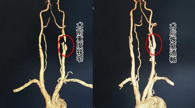 【典型病例】66岁颈动脉狭窄大爷感慨:做完手术眼不花了,脑袋也清醒了