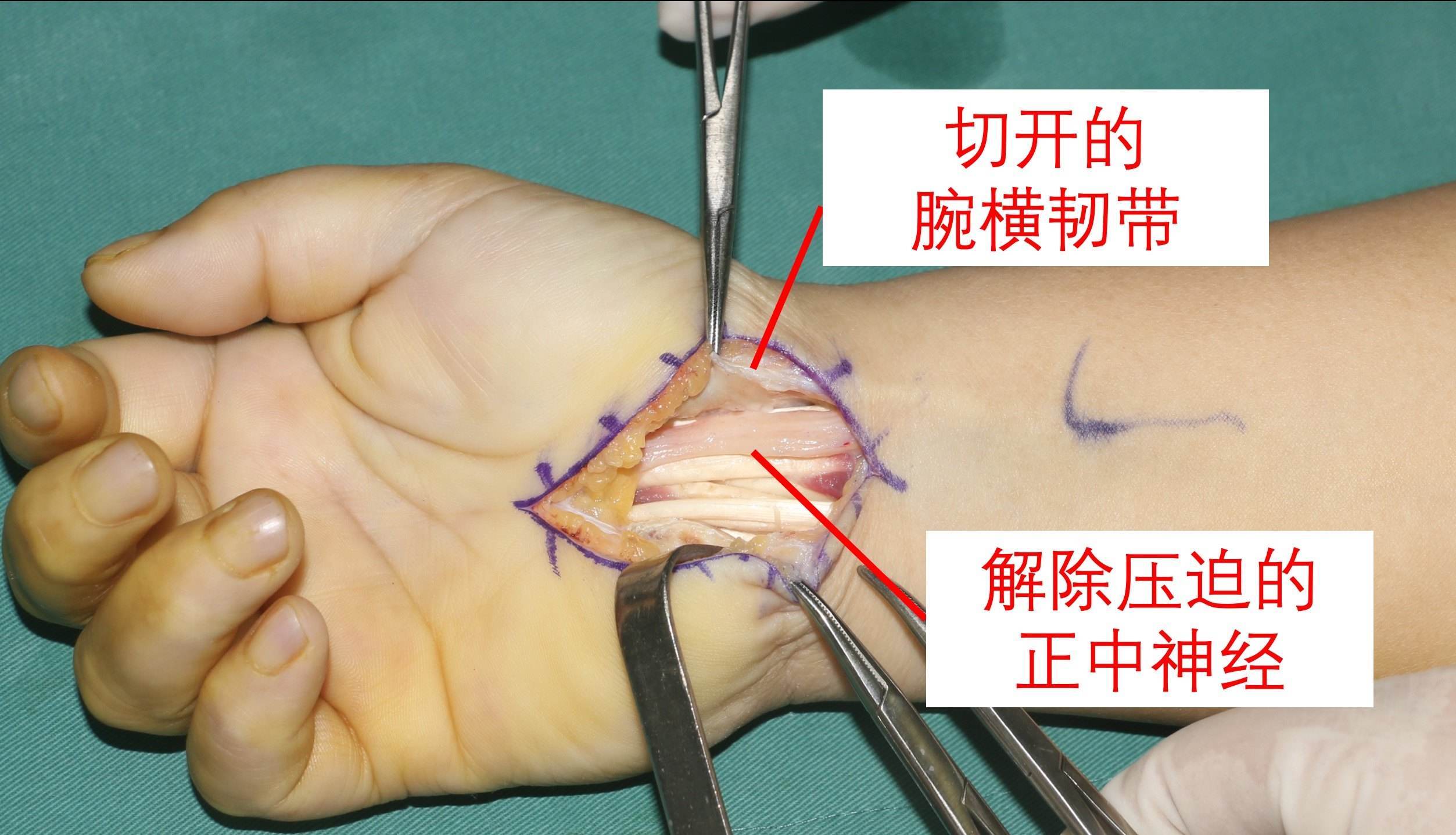 腕管综合征手术过程图图片