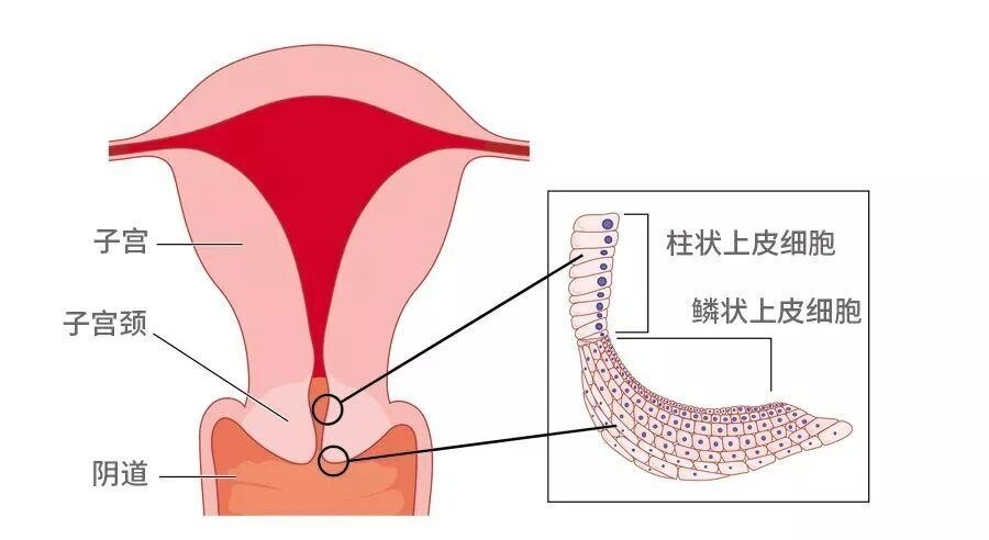 宫颈癌前病变