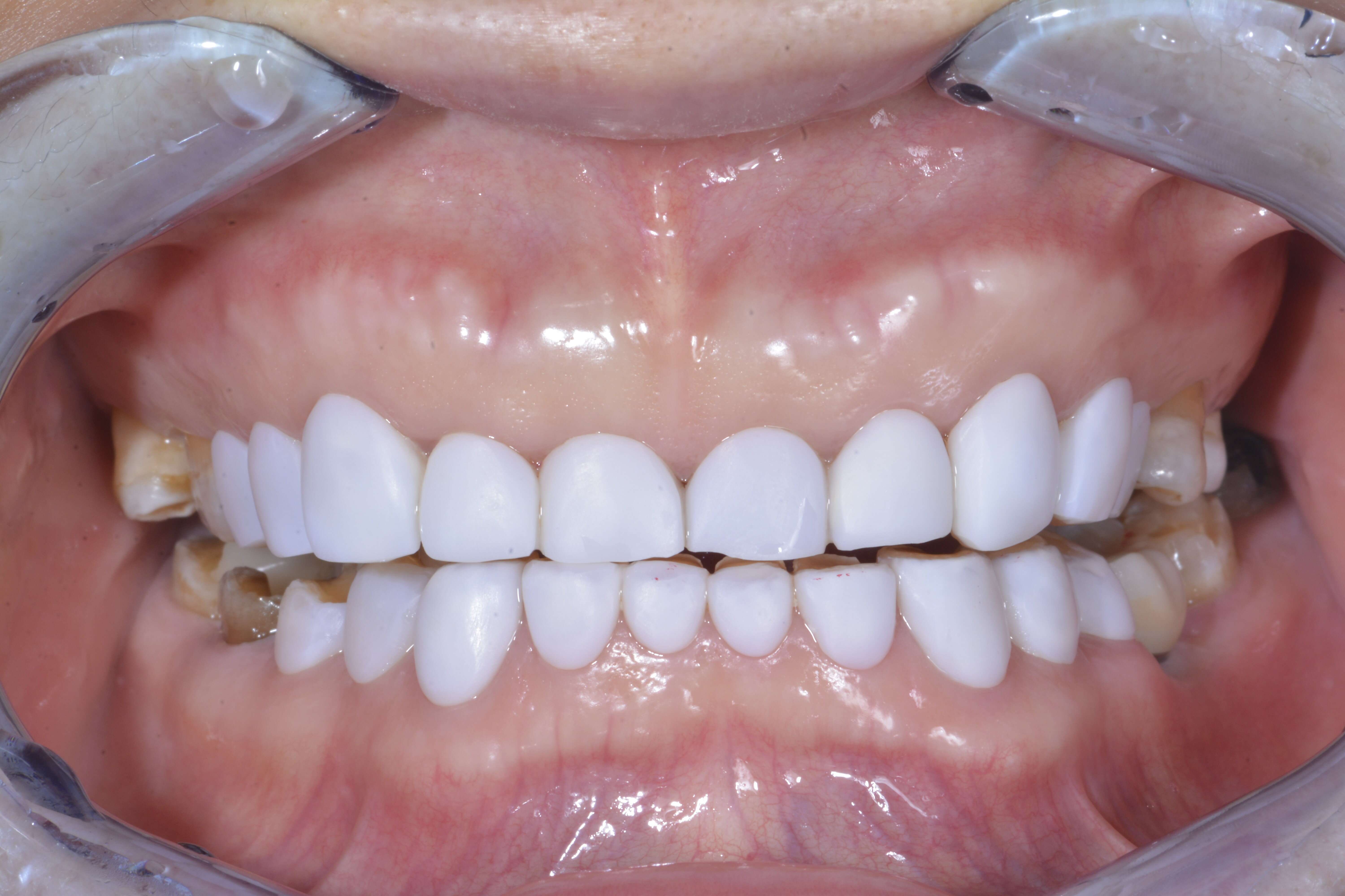 中切牙雕牙的过程图片图片