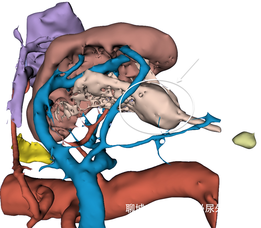 左肾盂肿瘤-1762569杨书凯.png