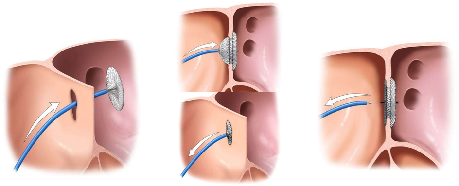 不开刀,不吃射线治疗房间隔缺损--食道超声引导下经股静脉房缺封堵术