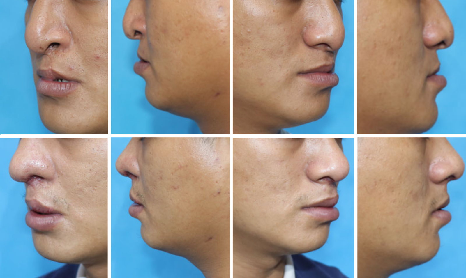 唇裂鼻畸形二期修复重建 - 知乎