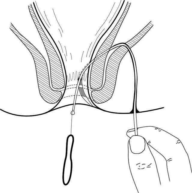 肛瘘换药步骤图图片