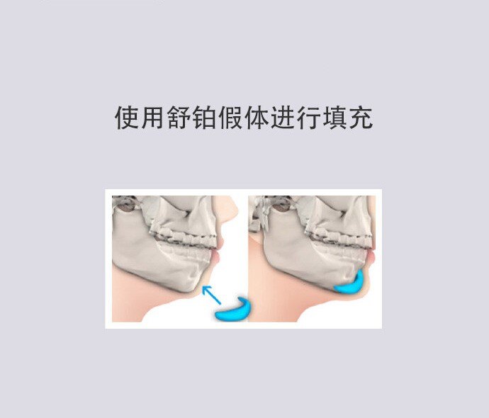 假体垫下巴后会出现位移变形吗