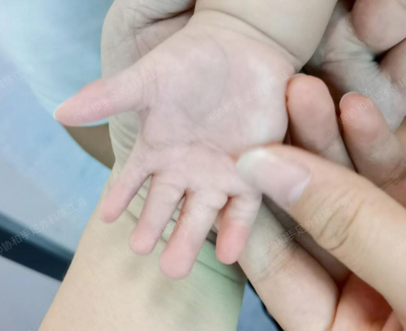 宝宝手指粘连在一起,如何处理孩子手指畸形和心理健康?