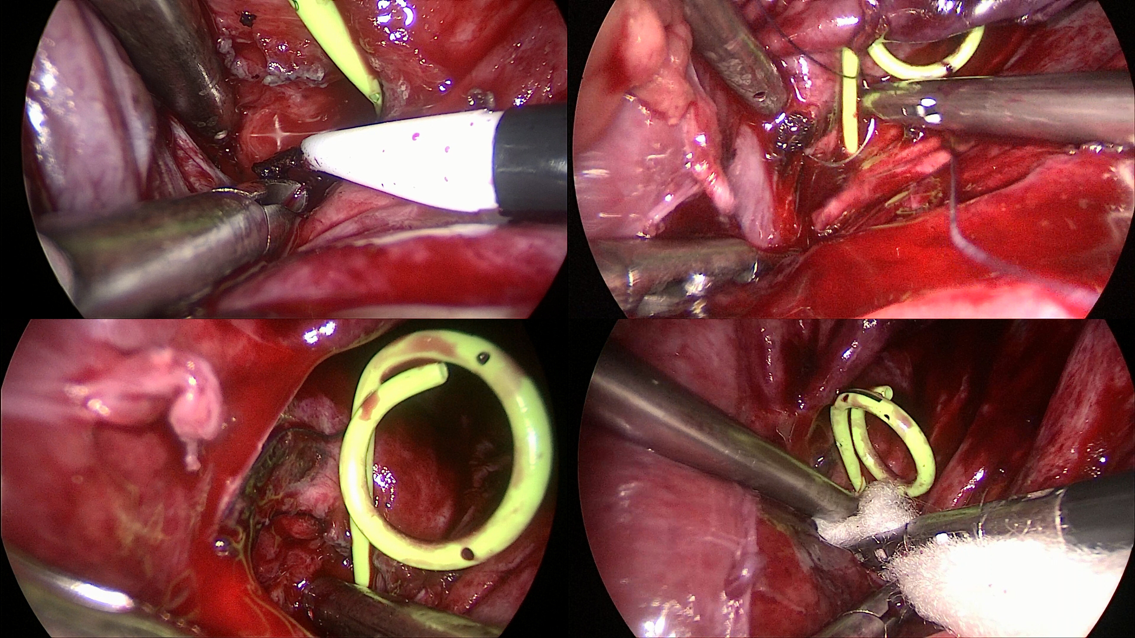 复杂性上尿路结石治疗需要建立个体化治疗体系_尿道结石_尿道结石治疗