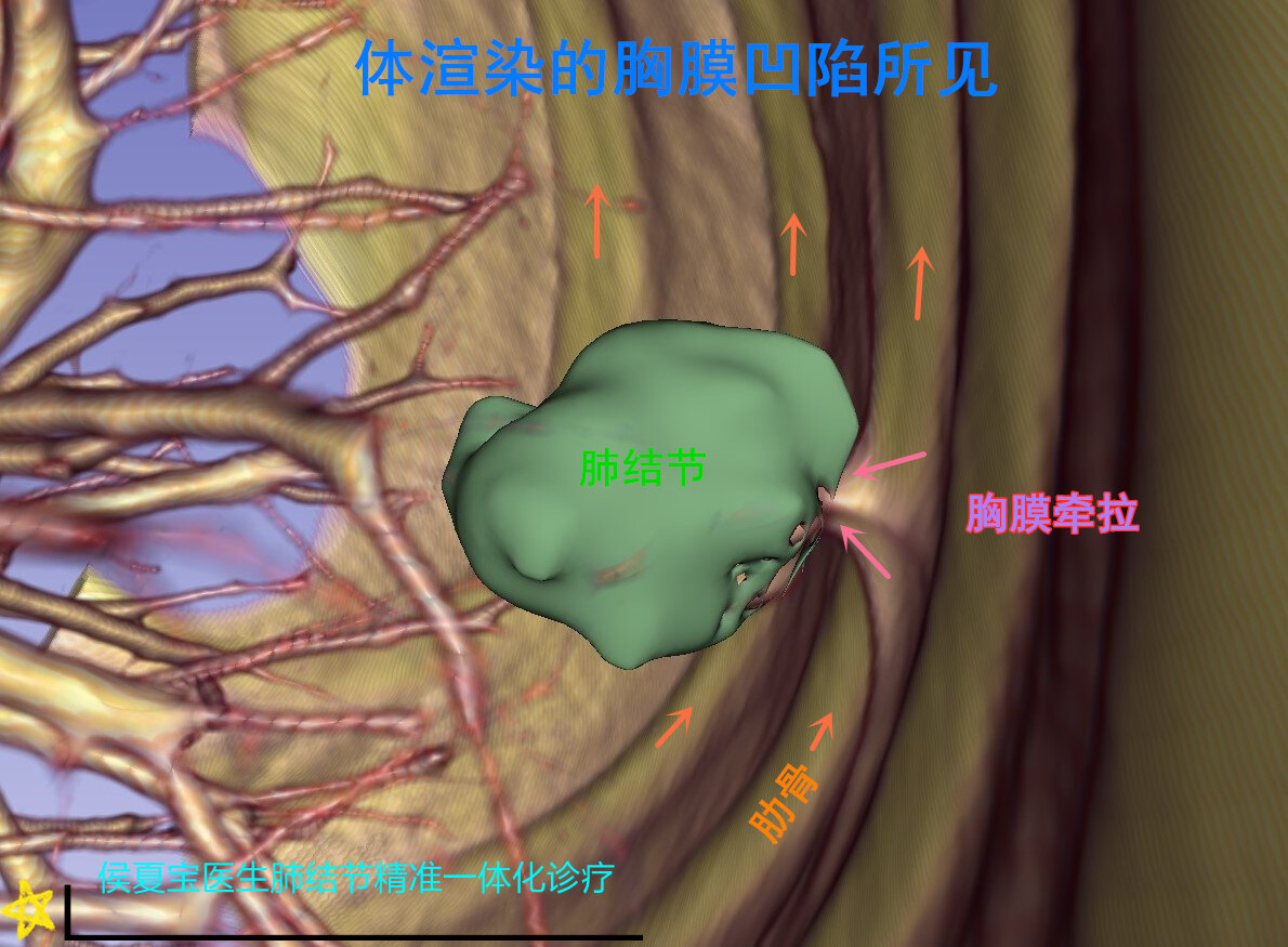 胸膜牵拉.jpg