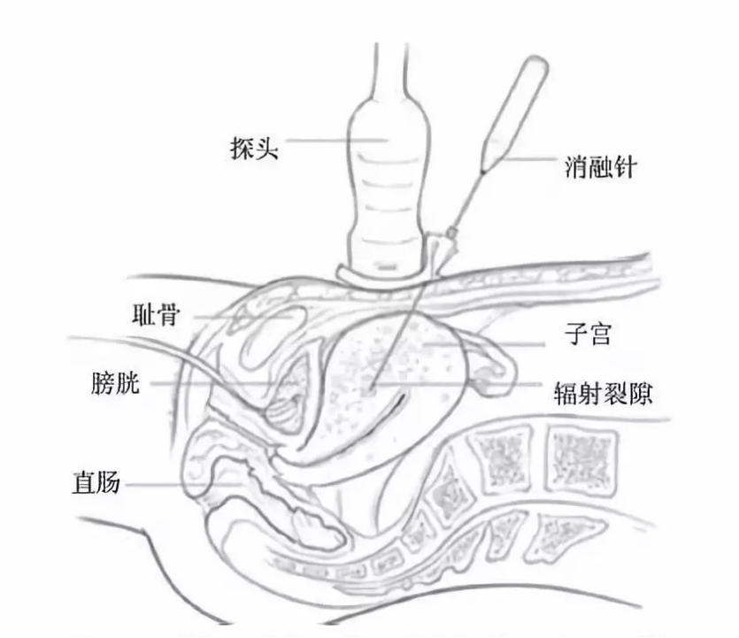 子宫腺肌症2.png