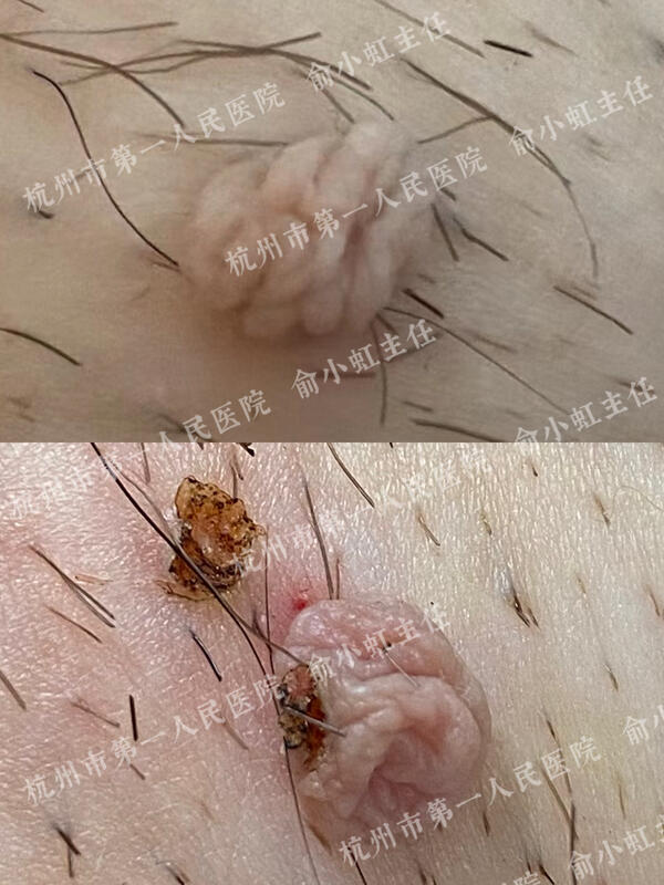 肛门软纤维瘤图片