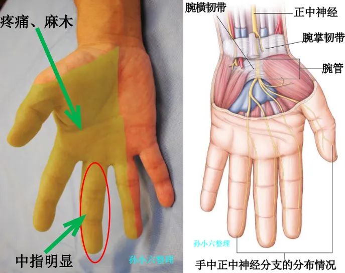 腕管综合征