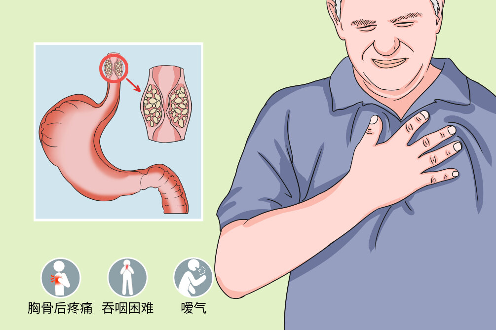 食管癌.jpg