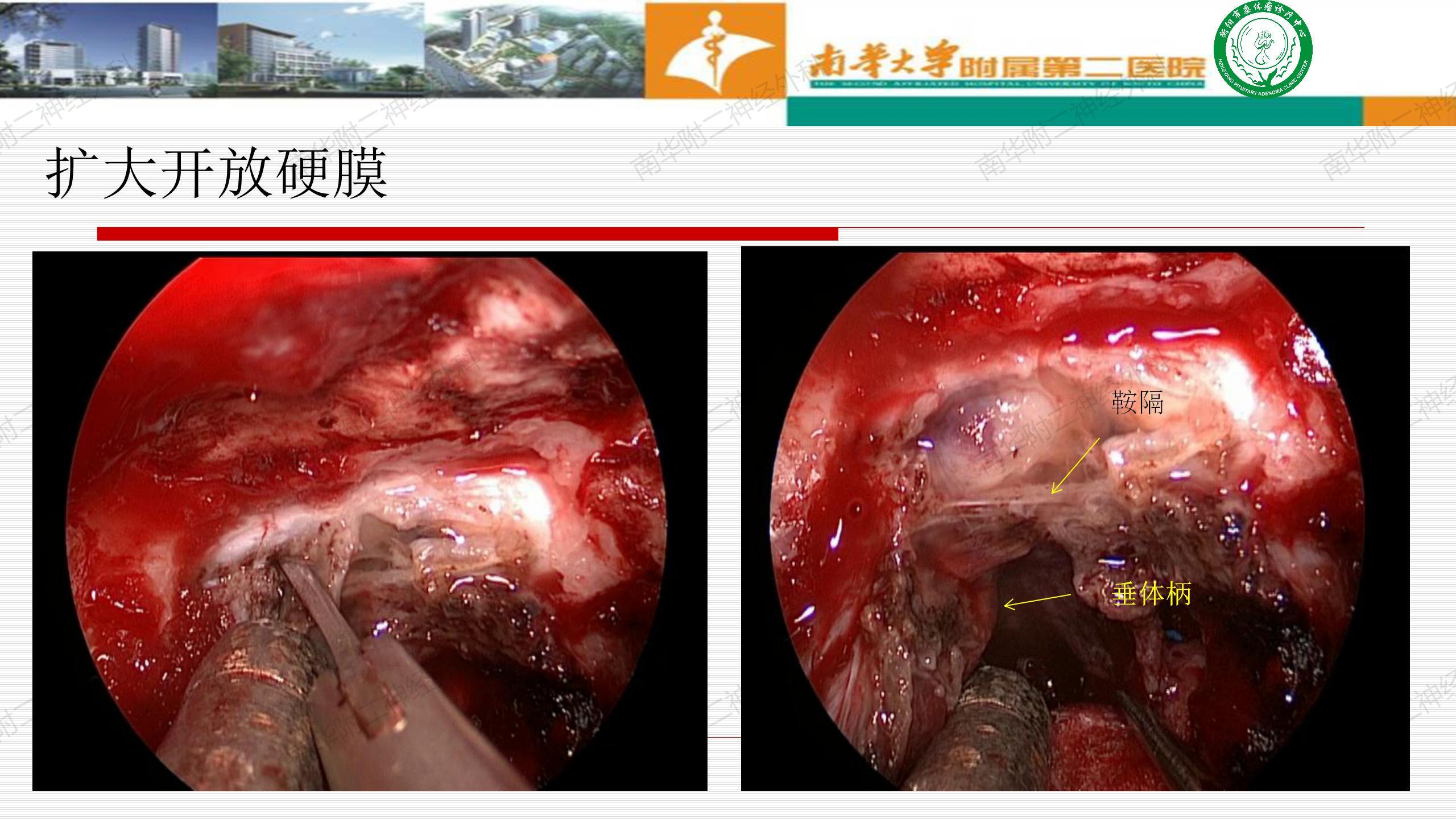 经鼻蝶垂体瘤手术步骤图片