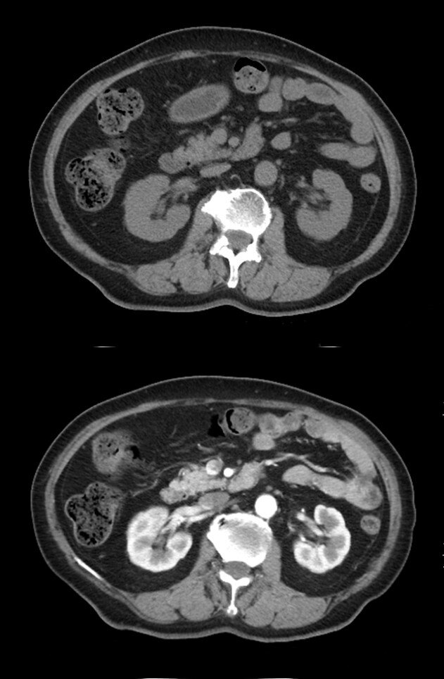 乳糜尿的膀胱镜下的直视显影 - 好大夫在线