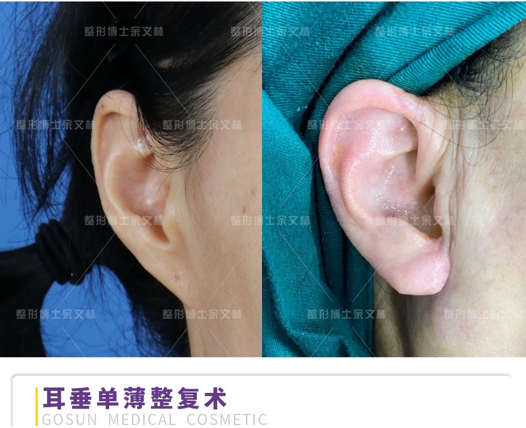 丰耳垂术助你拥有饱满丰盈的耳垂