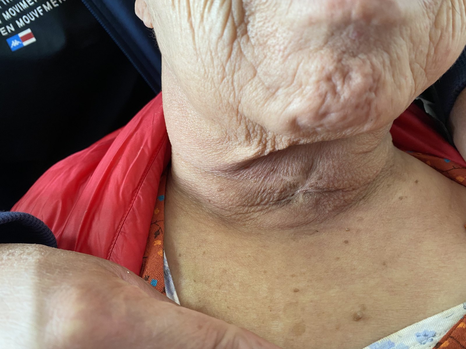 甲状腺癌医案,中医治疗肿瘤不只是扶正 - 好大夫在线