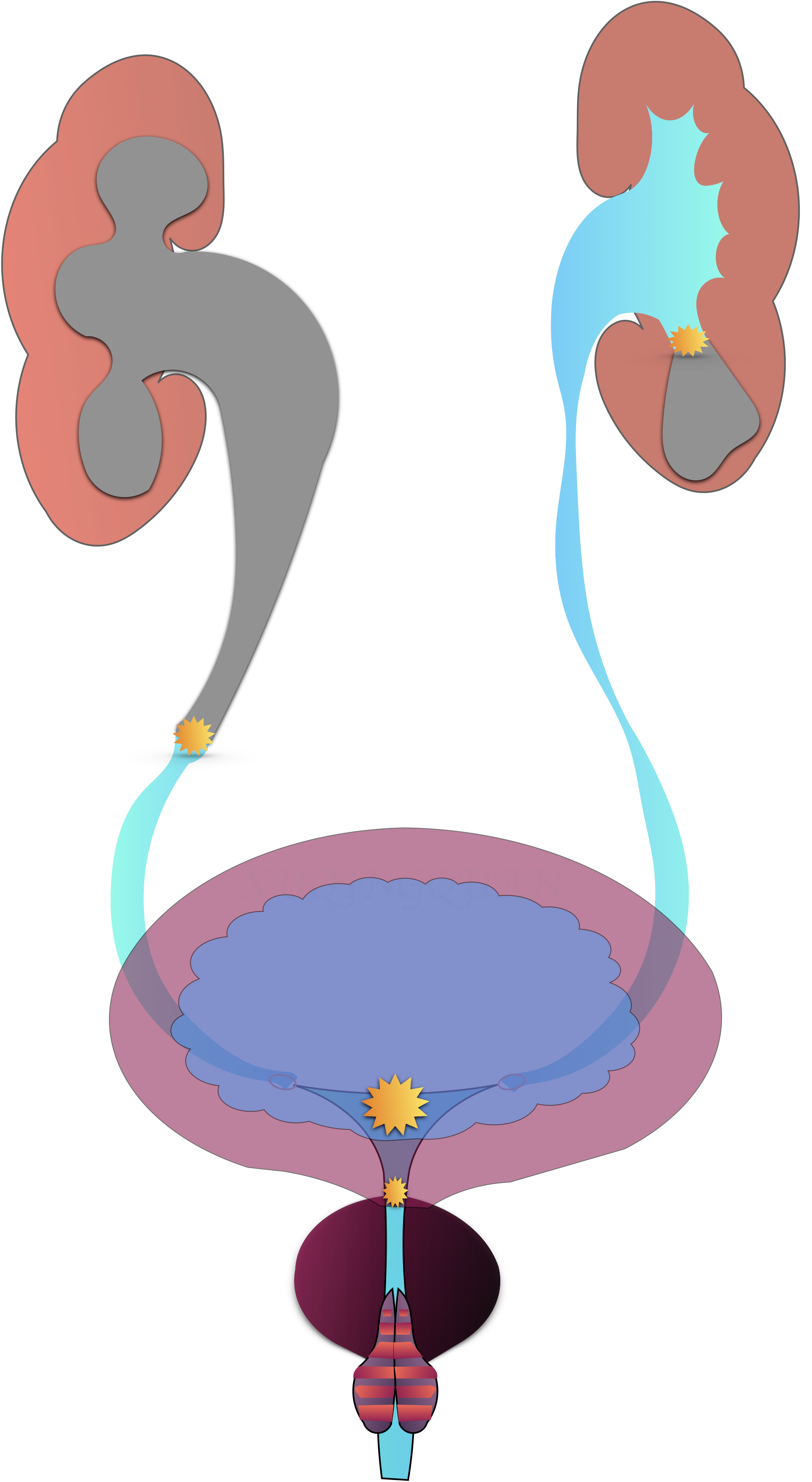 尿路结石治疗要抓住重点