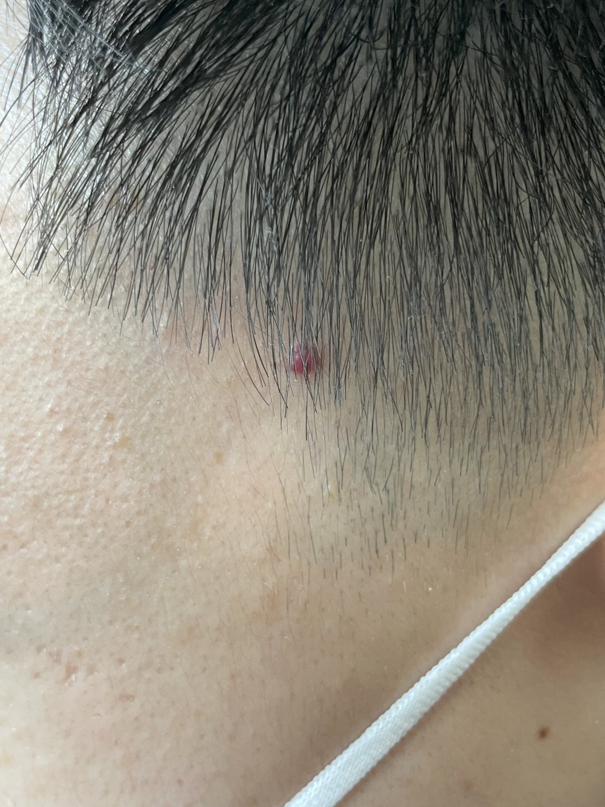 年轻人脸上胳膊上起了好多红痦子是血液问题吗