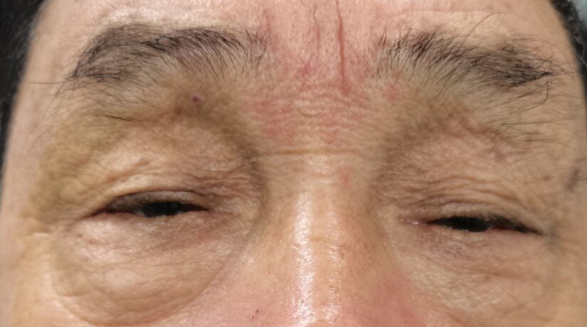 莫亚主任医师谈老年人眼睛睁不大_眼部疾病 - 好大夫在线