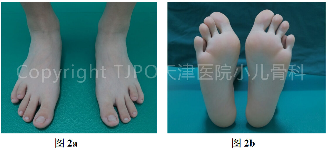 Tjpo儿童矫形科普 11 Mini轨道外固定支架矫正跖骨短缩畸形 先天性足畸形 先天性足畸形治疗方式 好大夫在线 Tjpo儿童矫形科普 11 Mini轨道外固定支架矫正跖骨短缩畸形 先天性足畸形 先天性足畸形治疗方式 好大夫在线