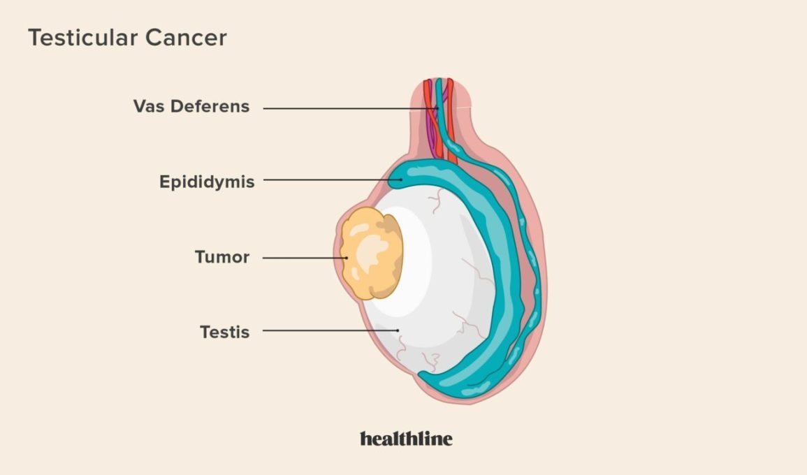 testicular-cancer.jpeg