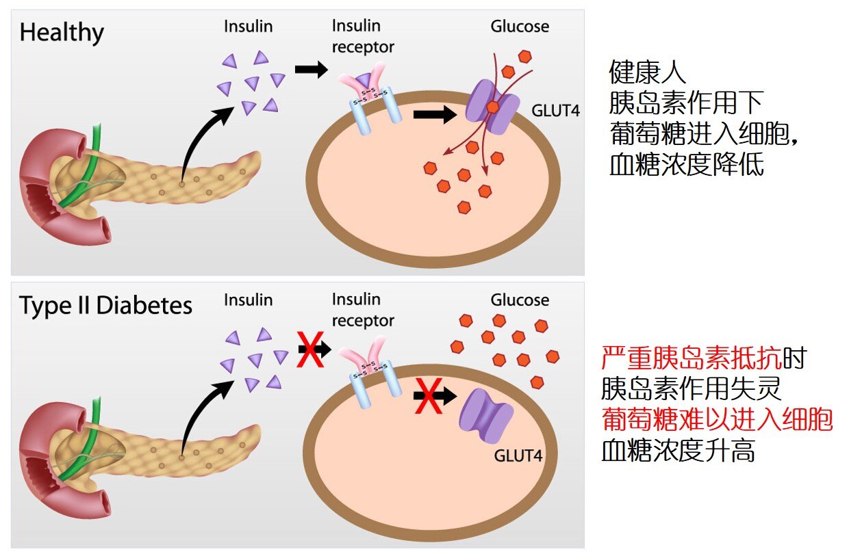 胰岛素抵抗对生育的影响 - 好大夫在线