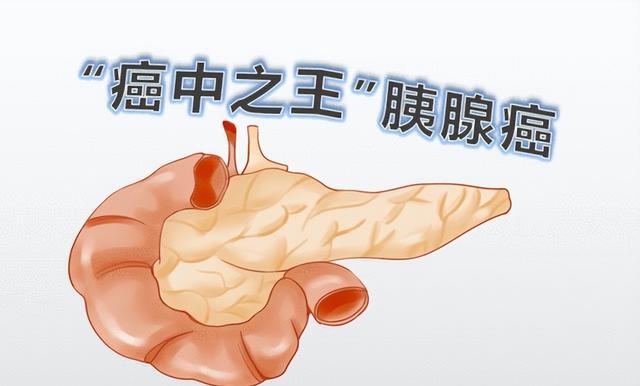 怎样才能不得胰腺癌 1oYBAGaLnsqAF-JLAABh3hkUMHo681.jpg?_ms_=9757