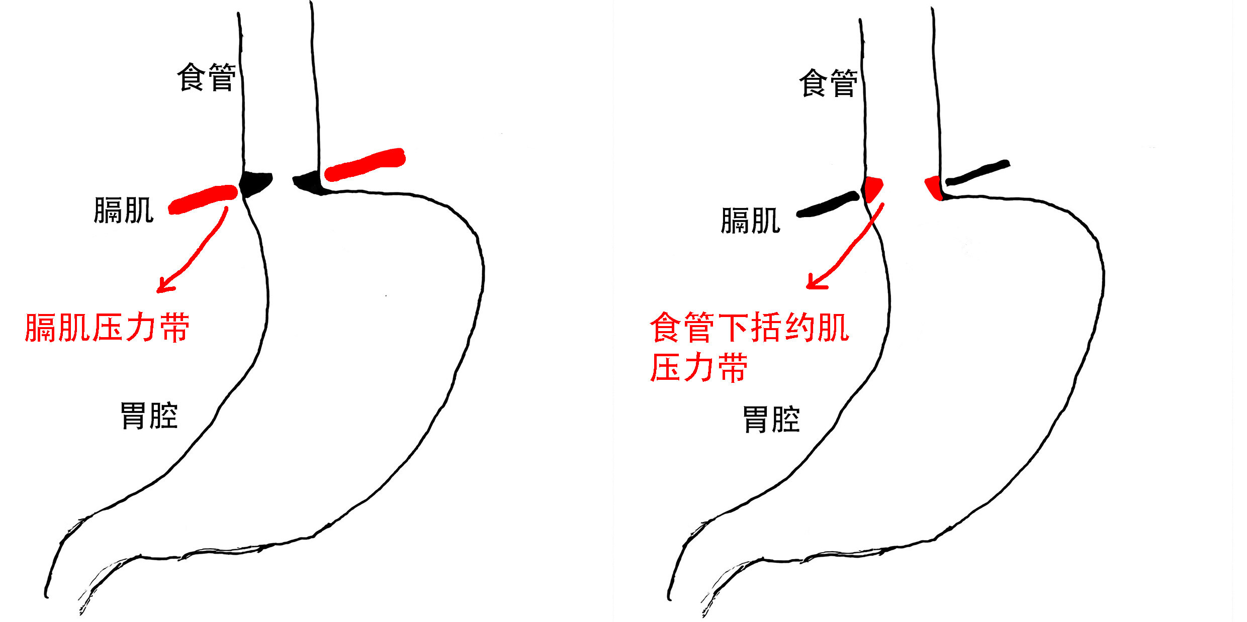 两条压力带.jpg