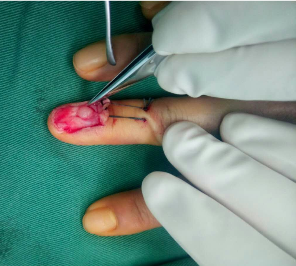 手指血管瘤图片大人图片