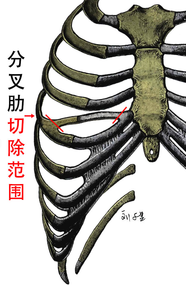 首先说说相关的解剖知识,第1至7肋骨借助前端的肋软骨与胸骨相连接.