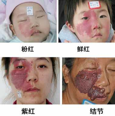 起初皮损表现为单个或数个大小不一的淡红色斑片,边