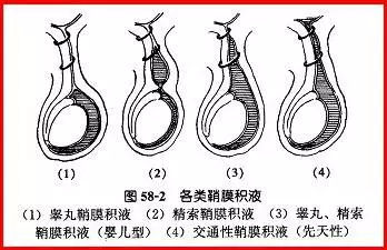 睾丸鞘膜积液对睾丸的影响鞘膜积液较少时,阴囊张力不大,对睾丸发育
