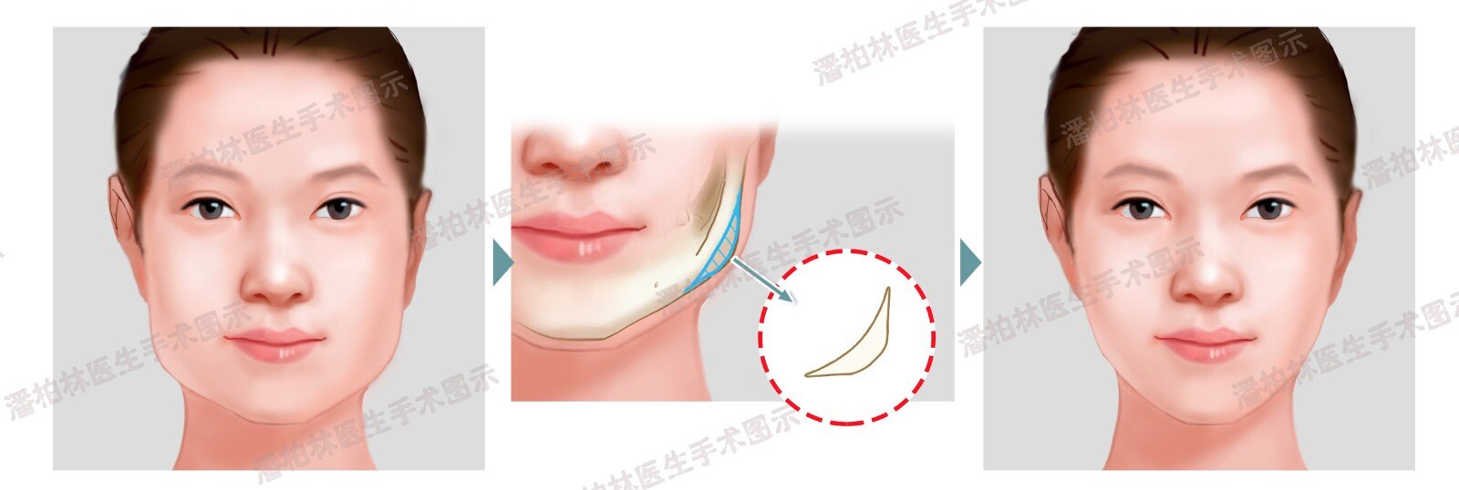 手术治疗 男→女(mtf)_整形_整形相关疾病 - 好大夫在线