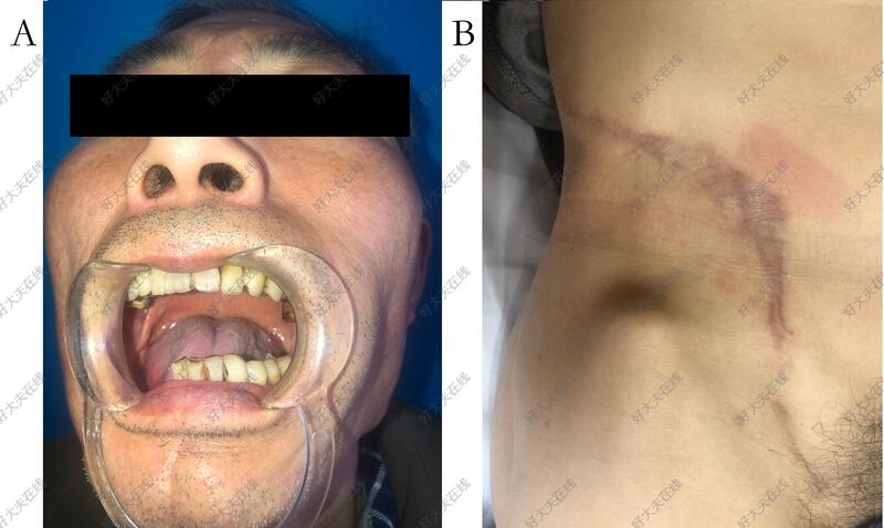 牙龈癌手术后面部照片图片