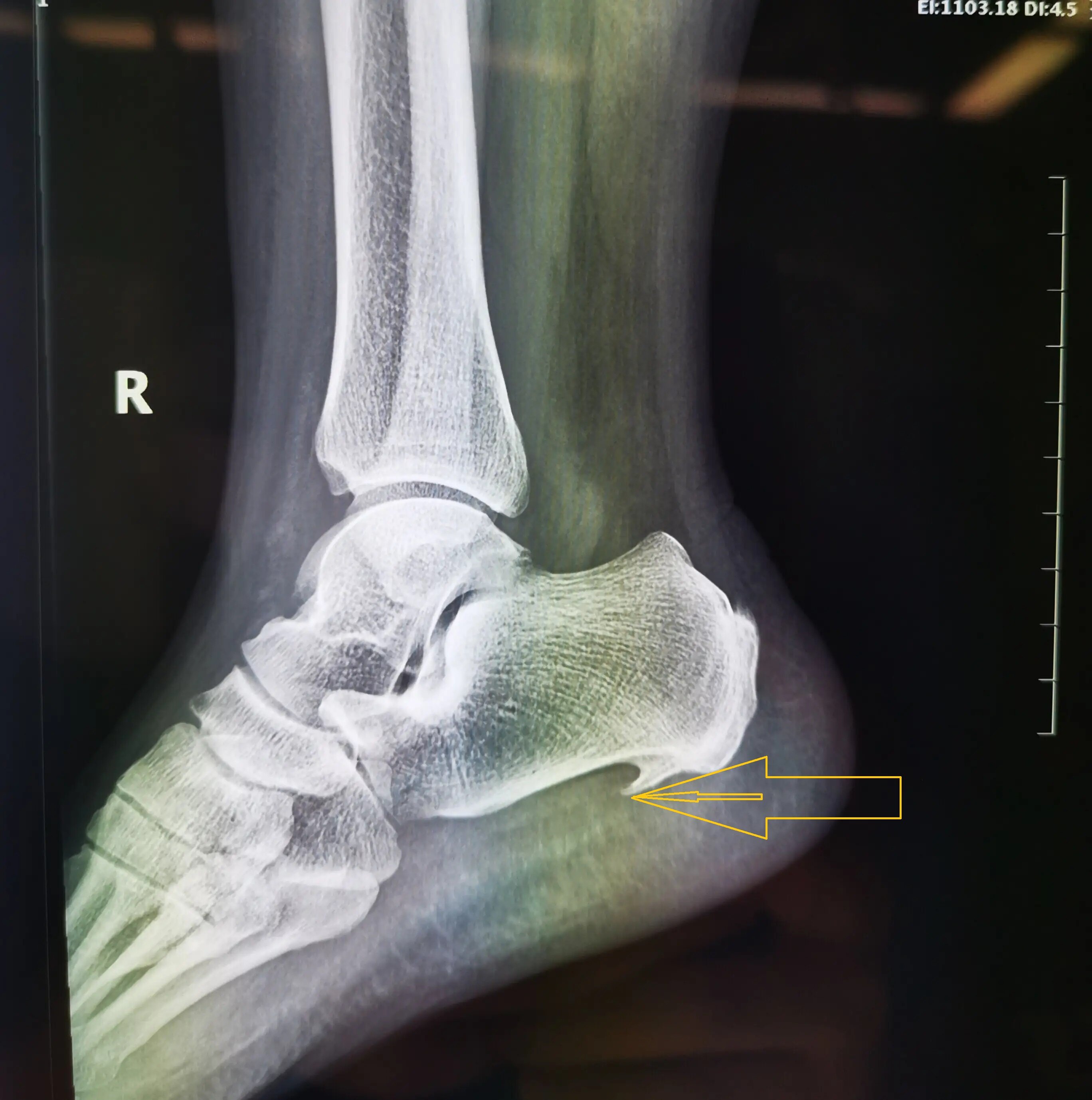 多见于老年患者,当有脚后跟痛时,经过拍摄x光片,可以发现跟骨结节处有