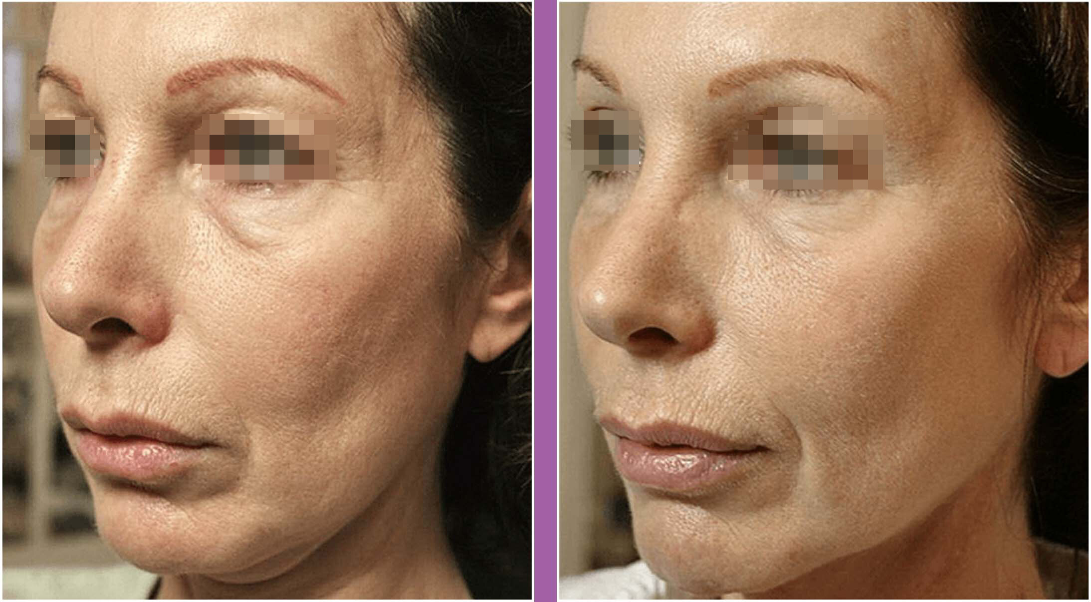 脸部提拉紧致:超声刀和热玛吉,哪个更好?能代替拉皮手术吗?