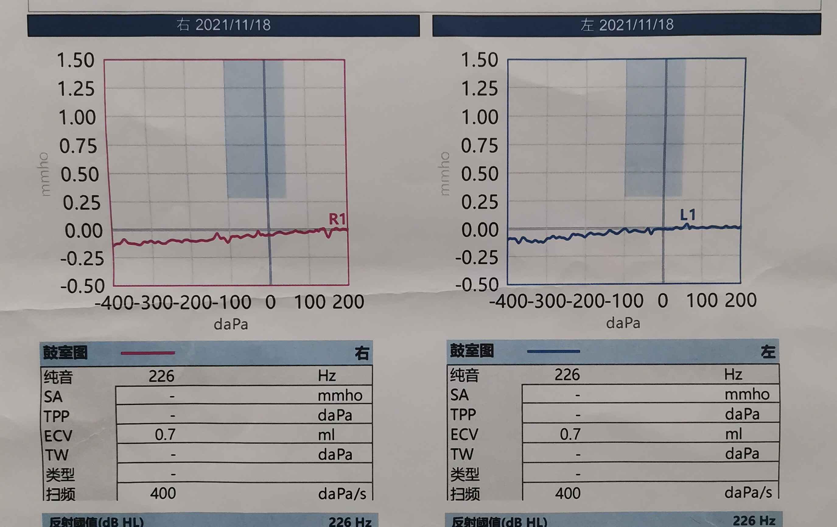 图一,患儿声导抗检查结果显示双耳b型鼓室功能曲线图二,纯音测听显示